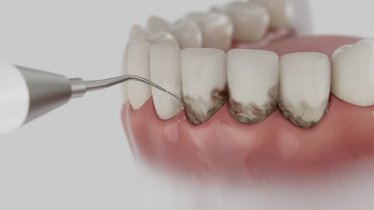 Reliable Dental Implants contractor in Bluffton, IN by Smile Center Dentistry